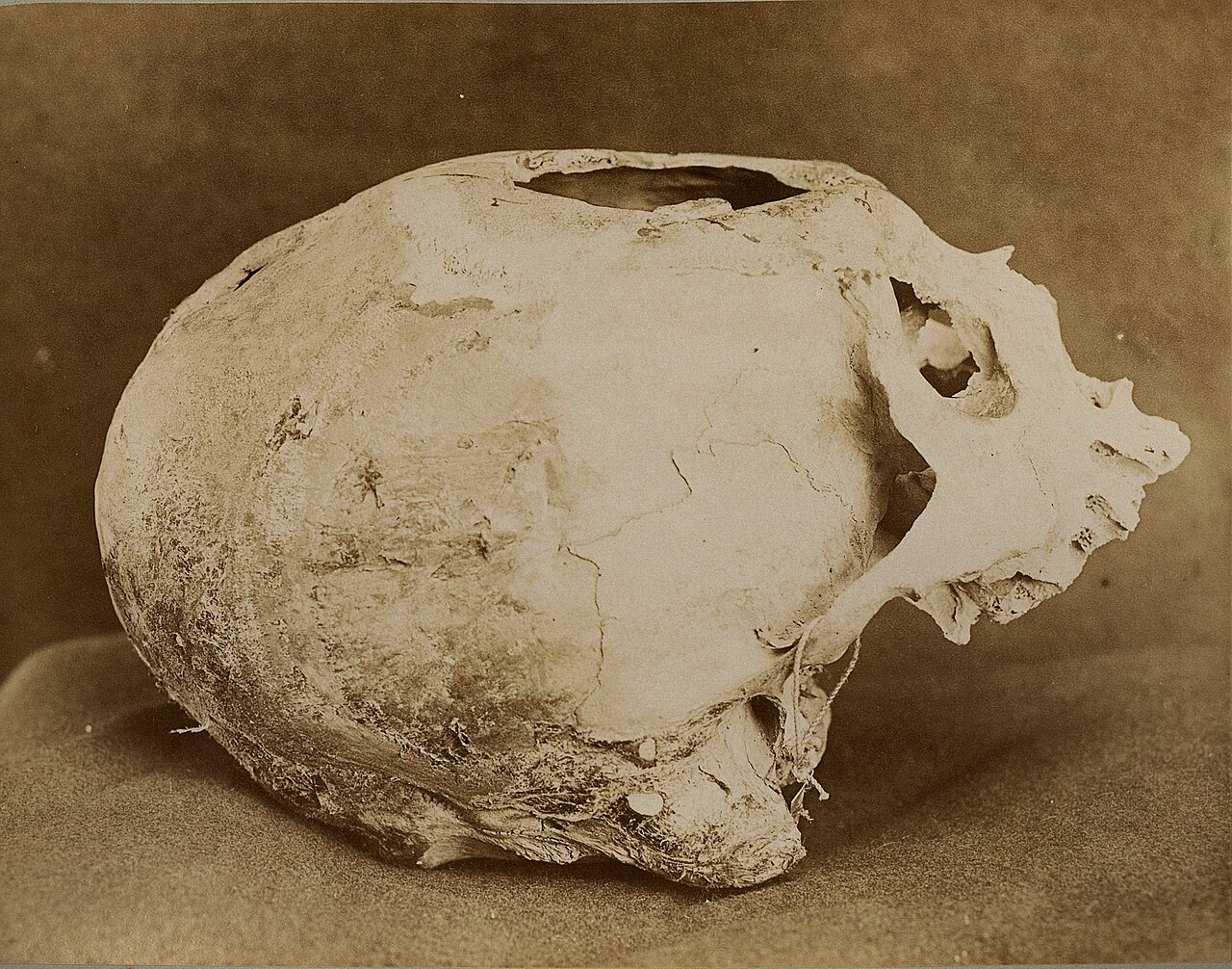 A historical depiction of trepanning, the ancient practice of opening the skull