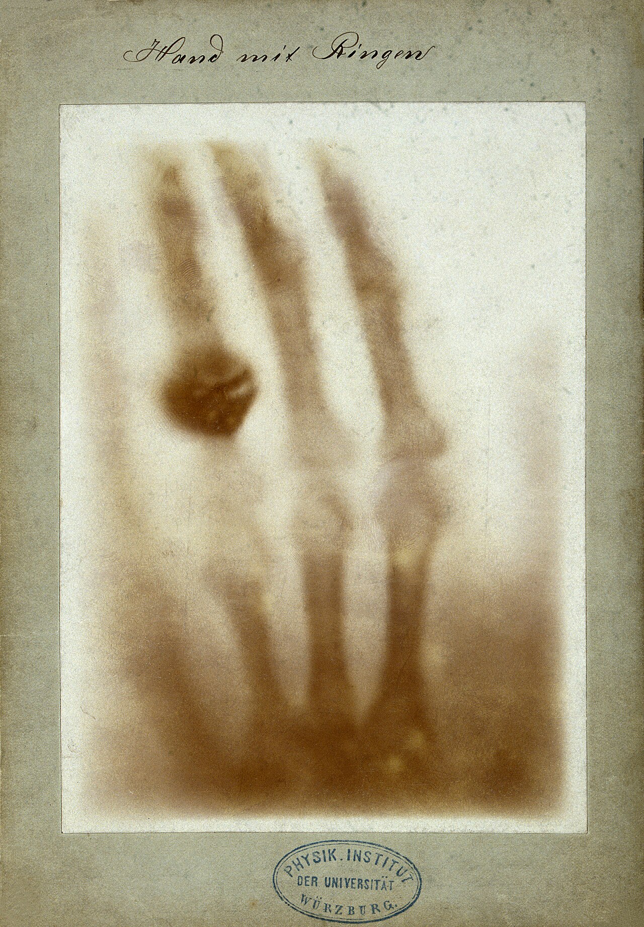 An early X-ray image showing the bones of a human hand wearing a ring